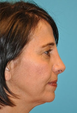 Rhinoplasty (Nose Job) Before and After Photos Case 4243 After Photo Rhinoplasty (Nose Job) Before and After Photos