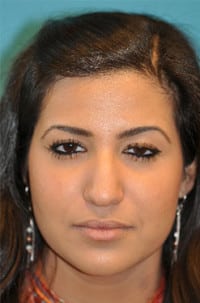 Rhinoplasty (Nose Job) Before and After Photos