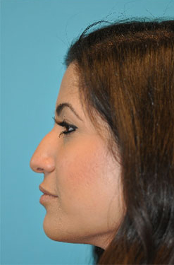 Rhinoplasty (Nose Job) Before and After Photos