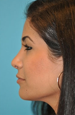 Rhinoplasty (Nose Job) Before and After Photos