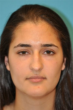 Rhinoplasty (Nose Job) Before and After Photos Case 4255 Before Photo Rhinoplasty (Nose Job) Before and After Photos