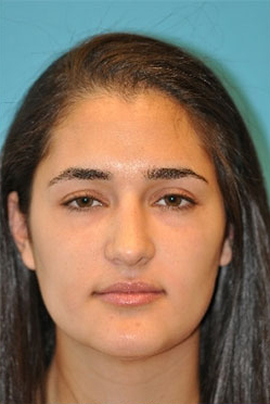 Rhinoplasty (Nose Job) Before and After Photos Case 4255 After Photo Rhinoplasty (Nose Job) Before and After Photos