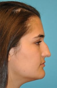 Rhinoplasty (Nose Job) Before and After Photos