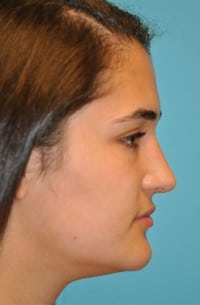 Rhinoplasty (Nose Job) Before and After Photos