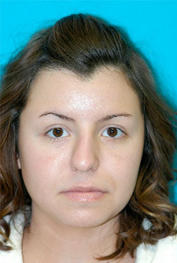 Rhinoplasty (Nose Job) Case 4261 Before Photo Rhinoplasty (Nose Job)