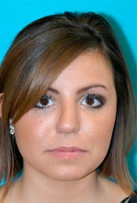 Rhinoplasty (Nose Job) Before and After Photos