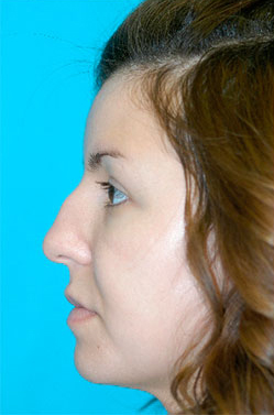 Rhinoplasty (Nose Job) Case 4261 Before Photo Rhinoplasty (Nose Job)