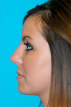 Rhinoplasty (Nose Job) Case 4261 After Photo Rhinoplasty (Nose Job)