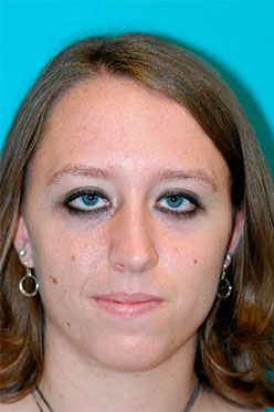 Rhinoplasty (Nose Job) Before and After Photos Case 4267 Before Photo Rhinoplasty (Nose Job) Before and After Photos