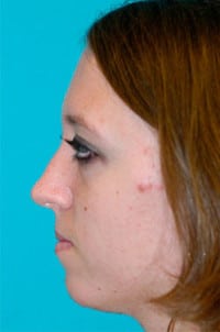 Rhinoplasty (Nose Job) Before and After Photos