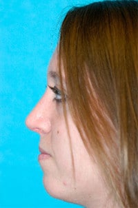 Rhinoplasty (Nose Job) Before and After Photos