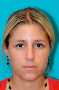 Rhinoplasty (Nose Job) Before and After Photos