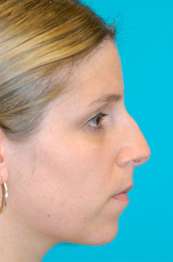 Rhinoplasty (Nose Job) Before and After Photos