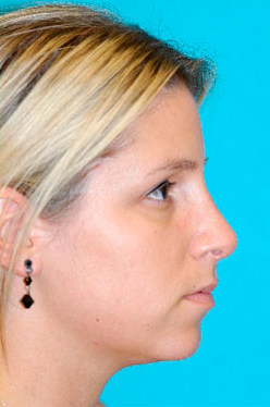 Rhinoplasty (Nose Job) Before and After Photos