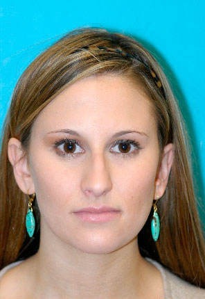 Rhinoplasty (Nose Job) Case 4279 Before Photo Rhinoplasty (Nose Job)