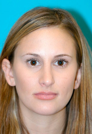Rhinoplasty (Nose Job) Case 4279 After Photo Rhinoplasty (Nose Job)