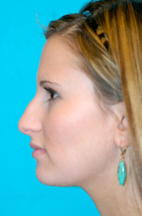 Rhinoplasty (Nose Job) Before and After Photos