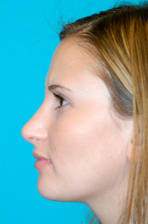 Rhinoplasty (Nose Job) Case 4279 After Photo Rhinoplasty (Nose Job)