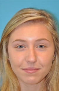 Rhinoplasty (Nose Job) Before and After Photos