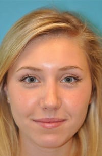 Rhinoplasty (Nose Job) Before and After Photos