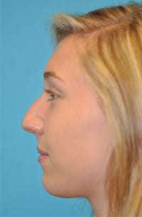 Rhinoplasty (Nose Job) Before and After Photos