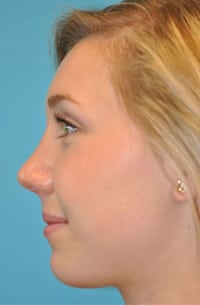 Rhinoplasty (Nose Job) Before and After Photos