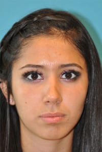 Rhinoplasty (Nose Job) Before and After Photos
