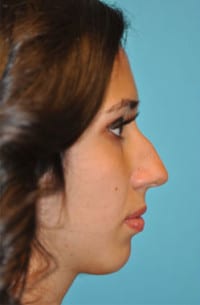 Rhinoplasty (Nose Job) Before and After Photos