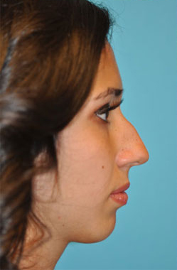 Rhinoplasty (Nose Job) Before and After Photos