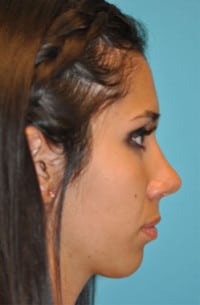 Rhinoplasty (Nose Job) Before and After Photos