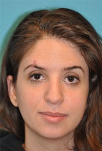 Rhinoplasty (Nose Job) Before and After Photos