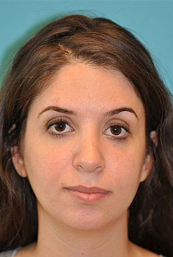 Rhinoplasty (Nose Job) Before and After Photos Case 4297 After Photo Rhinoplasty (Nose Job) Before and After Photos
