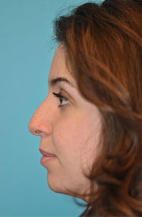Rhinoplasty (Nose Job) Before and After Photos