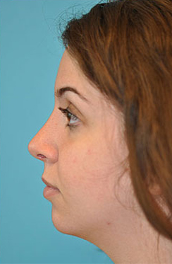 Rhinoplasty (Nose Job) Before and After Photos Case 4297 After Photo Rhinoplasty (Nose Job) Before and After Photos
