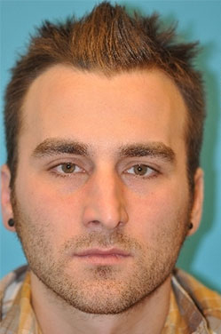 Rhinoplasty (Nose Job) Before and After Photos Case 4303 Before Photo Rhinoplasty (Nose Job) Before and After Photos