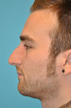 Rhinoplasty (Nose Job) Before and After Photos Case 4303 Before Photo Rhinoplasty (Nose Job) Before and After Photos