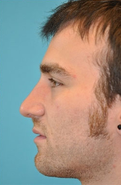 Rhinoplasty (Nose Job) Before and After Photos Case 4303 After Photo Rhinoplasty (Nose Job) Before and After Photos