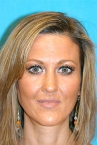 Rhinoplasty (Nose Job) Before and After Photos