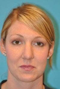 Rhinoplasty (Nose Job) Before and After Photos