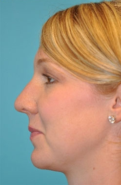 Rhinoplasty (Nose Job)