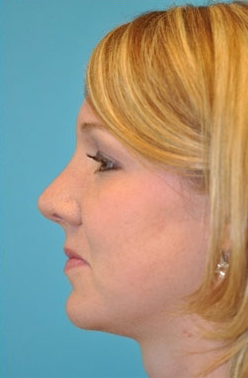 Rhinoplasty (Nose Job)