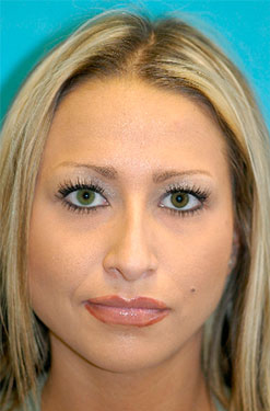 Rhinoplasty (Nose Job) Before and After Photos Case 4321 Before Photo Rhinoplasty (Nose Job) Before and After Photos