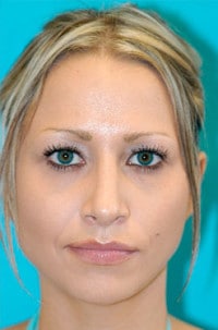 Rhinoplasty (Nose Job) Before and After Photos