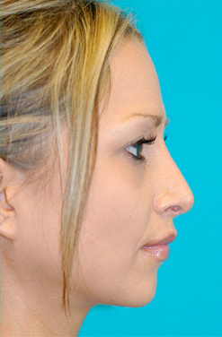 Rhinoplasty (Nose Job) Before and After Photos Case 4321 After Photo Rhinoplasty (Nose Job) Before and After Photos
