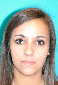 Rhinoplasty (Nose Job) Before and After Photos