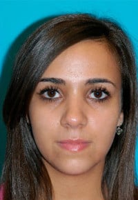 Rhinoplasty (Nose Job) Before and After Photos