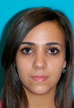 Rhinoplasty (Nose Job) Before and After Photos