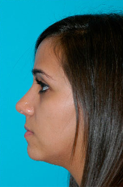 Rhinoplasty (Nose Job) Before and After Photos