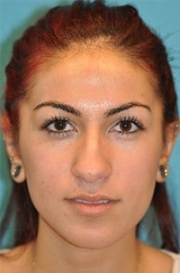 Rhinoplasty (Nose Job) Before and After Photos