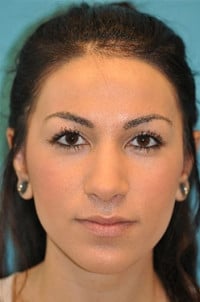 Rhinoplasty (Nose Job) Before and After Photos